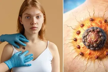 Cilt kanseri sinsice yayılıyor: Bu 4 belirtiye karşı tetikte olun! Avuç içi, ayak tabanı, kulaklar dahil...
