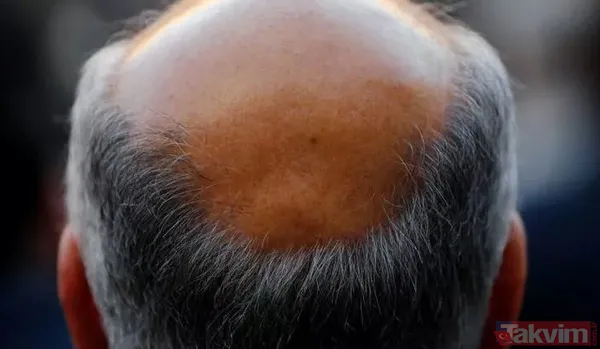 Kelliğin merhemi bulundu 40 yıl düşünsek aklımıza gelmez! Saçı olmayanlar bu haber sizin için müjde ki ne müjde - 3