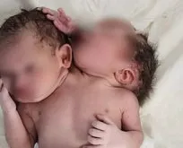 Doktorlar gözlerine inanamadı! Çift başlı bebek...