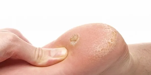 Topuk dikeni neden olur? Topuk dikeni belirtileri neler? Tedavisi var mı kendiliğinden geçer mi?-4