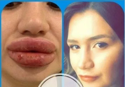 Merve'nin doktoru: Kalıcı dolgu vakası dünyada görülmemiştir-2