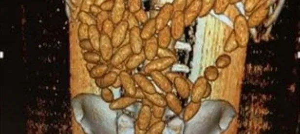 Midesinden 102 kapsül esrar çıktı