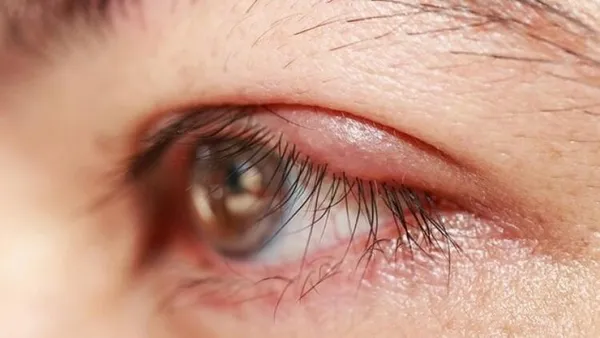 Uzman isim uyardı! Katarakt, 55 yaşından sonra kapıyı çalıyor | A'dan Z'ye göz sağlığı-7