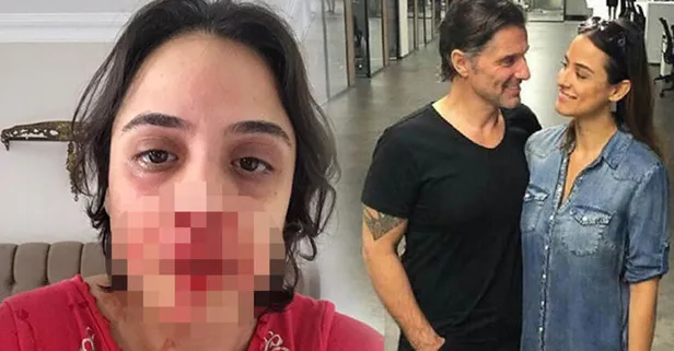 Hazım Körmükçü nişanlısı Zeynep Tandoğan’ı darp etti!-1