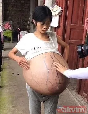 Bilim insanlarını şoke eden bu olay Çin’den! Herkes onu hamile sanıyor ama gizemi çözülemiyor
