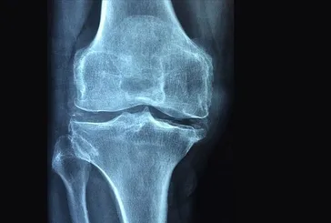 Kemik erimesi ailenizin eseri