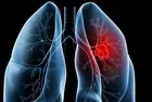 Akciğer tansiyonu kalbe vuruyor