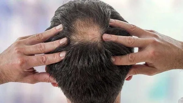 1 gecede 2 cm saç uzatıyor! Kafasında saçı kalmayana müjde! Saçı 5 katına çıkaran kür tarifi