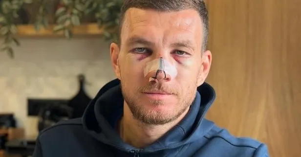 Dzeko maske ile oynayacak!