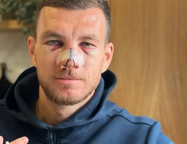 Dzeko maske ile oynayacak!