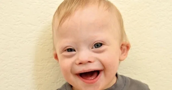 down sendromu nedir neden olur