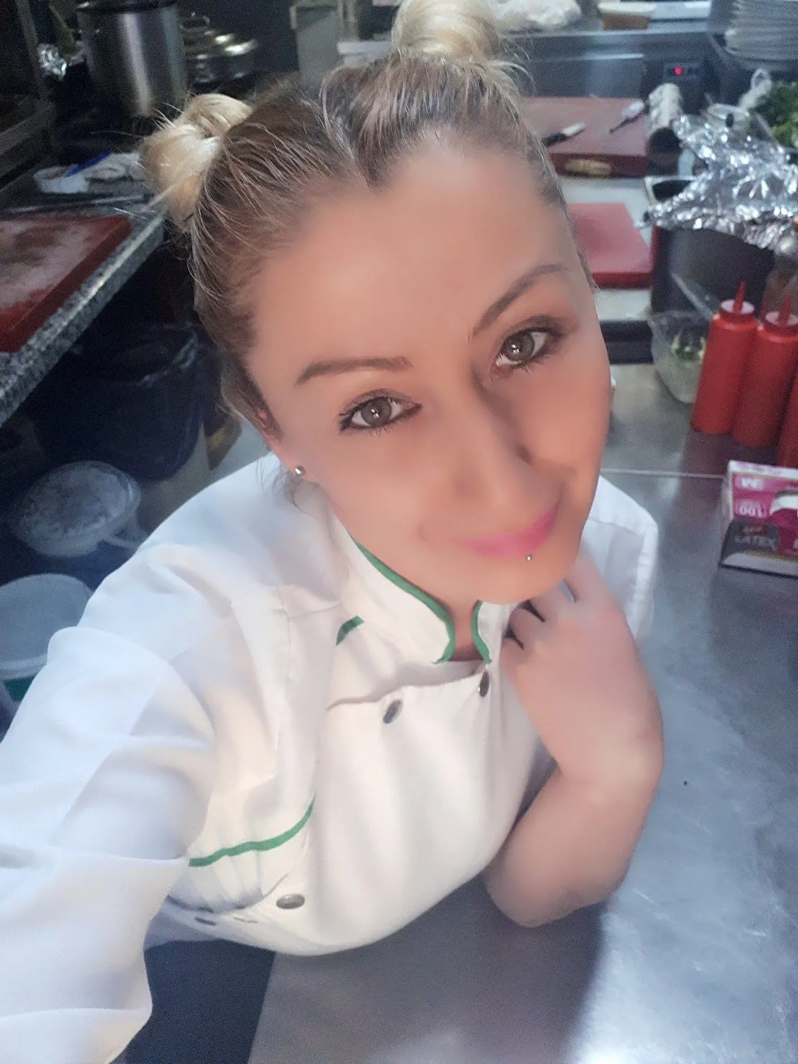 yine-estetik-faciasi-1783294625667.jpg Estetik işlem sonrası dudağı çürüdü: 4 ameliyat geçirdi-3