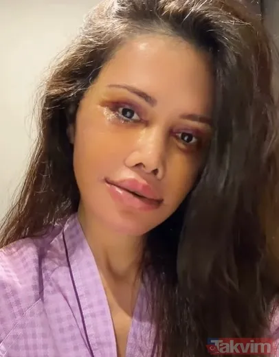 Eski Survivor yarışmacısı Didem Ceran Güney Kore'de 15 saatlik "yüz nakli" operasyonu geçirdi - 10