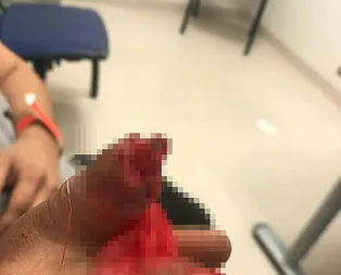 Kopan parmağını sırt çantasında Türkiye’ye getirdi!