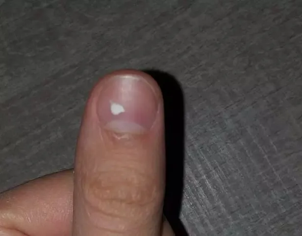 tirnaklardaki-beyaz-cizgilerin-nedeni-meger-buymus-herkes-farkli-biliyordu-meger-1697460588134.jpeg Tırnaklardaki beyaz çizgilerin nedeni meğer buymuş! Herkes farklı biliyordu: Duyunca çok şaşıracaksınız!-7