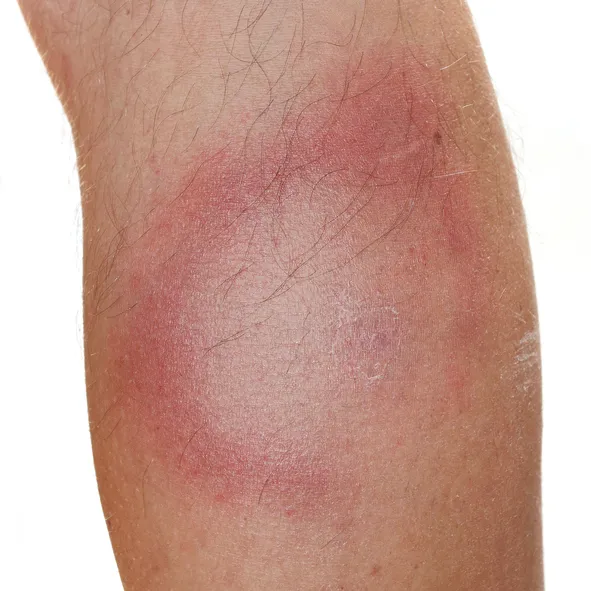 Lyme hastalığı nedir? AIDS'ten bile tehlikeli olan lyme hastalığı bulaşıcı mıdır? Lyme hastalığı tedavi edilebilir mi?  - 4