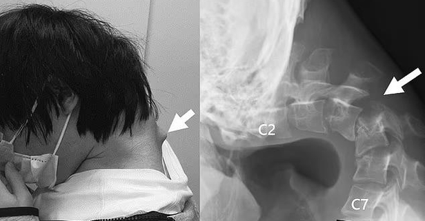 Şoke eden düşük kafa sendromu! Telefona bakmaktan boynu yamuldu vida taktılar