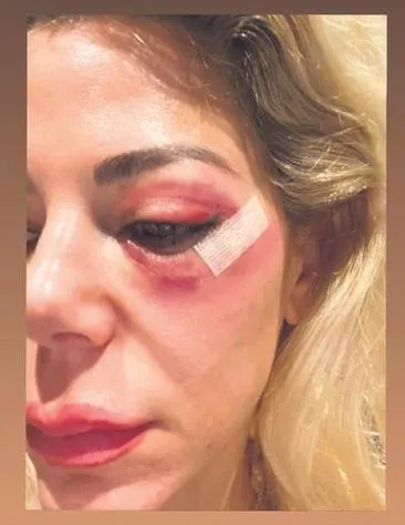 Sosyetik Burcu Şendir Kartalkaya’da ölümden döndü:-4