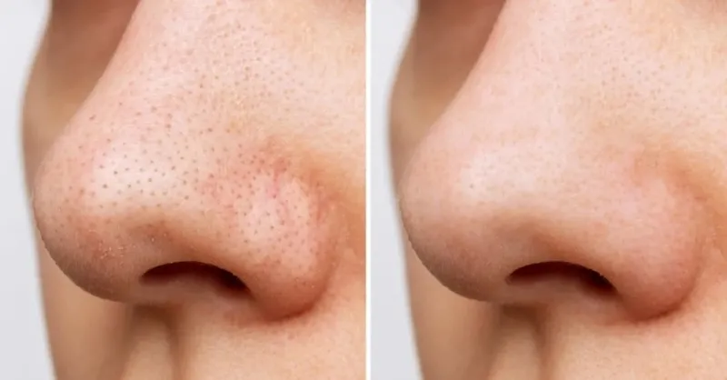 cildiniz-boyle-gorunuyorsa-3-sebebi-var-30-gunde-gozenek-kucultmenin-sirri-verildi-1719406910712.jpeg 30 günde gözenek küçültmenin sırrı verildi! Cildiniz böyle görünüyorsa 3 sebebi var!-3