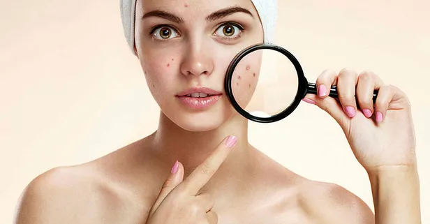 Rüyada irinli sivilce görmek hayırlı mıdır? Rüyada sivilce görmek neye yorumlanır, ne anlama gelir?