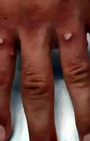 Yunanistan'da ilk maymun çiçeği vakası