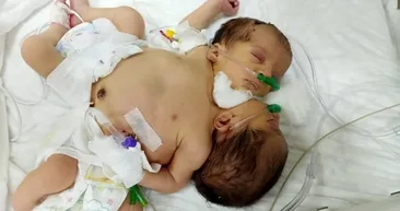 Afrinli yapışık ikizler, Hataya getirildi