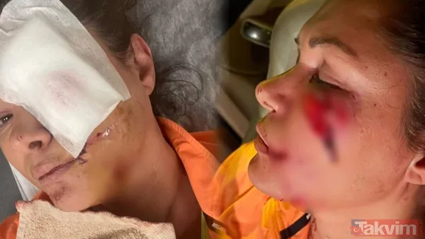 Köpek saldırısına uğrayan Tuğba Altıntop 'durum bu' deyip son halini yayınladı! Rafet El Roman’ın eski eşi hayranlarını korkutmuştu... - 5