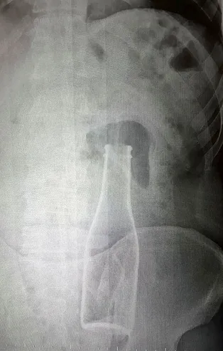 Vücudundan şişe çıkan Afgan genç: Yanlışlıkla oldu! Kimseden şikayetçi değilim