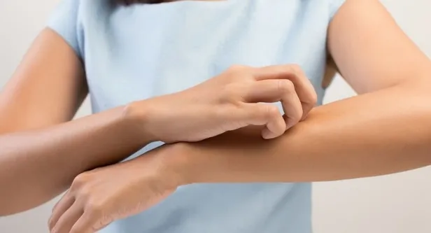 Kaşıntı ve kızarıklığa ne iyi gelir? Kaşıntıya iyi gelen doğal çözümler...-3