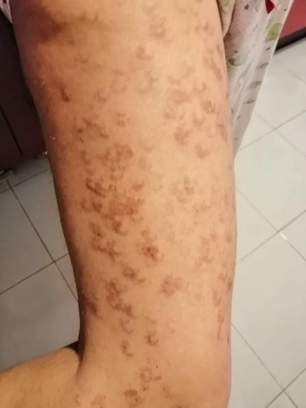 lazer-epilasyon-icin-guzellik-merkezine-gitti-vucudunda-1-derece-yaniklar-olustu-1617716797981.jpg Lazer epilasyon için güzellik merkezine gitti! Vücudunda 1. derece yanıklar oluştu-5