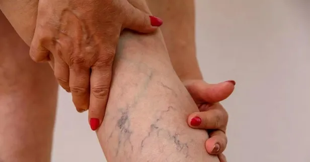 Varisleri olan hastaların yakınmalarını azaltacak 4 süper gıda