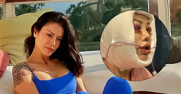 Didem Ceran'ın yüz nakli sonrası inanılmaz değişimi