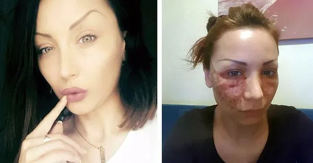 Estetik faciası! Bulgar model hayatının şokunu yaşadı! Bakın kendilerini nasıl savundu