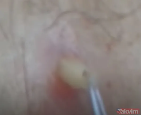 Karnındaki şişlik için gitti içinden çıkan doktorları bile şoke etti! Yer uzak değil Kayseri! 64 kilo girdi 55 kilo çıktı - 36