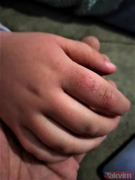 Antalya'da bir babanın iddiaları duyanları şoke etti! Parmaklarında yanık izleri, bileklerinde morluk... - 6