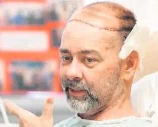 Dünyada ilk kafatası nakli