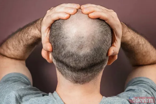 Kelliği tarihe gömüyor yapan göz alıcı sırma saçlara sahip oluyor! Saç ektirme işlemine servet dökmeden bu işi çözün - 3