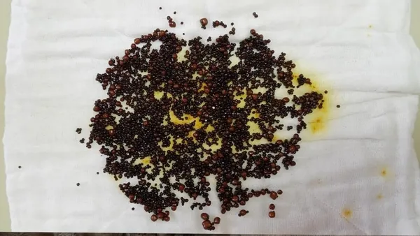 3-kisi-yarim-saatte-sayabildi-safra-kesesinden-5-bin-58-adet-tas-cikarildi-1622284748456.jpg 3 kişi yarım saatte sayabildi! Safra kesesinden 5 bin 58 adet taş çıkarıldı-2