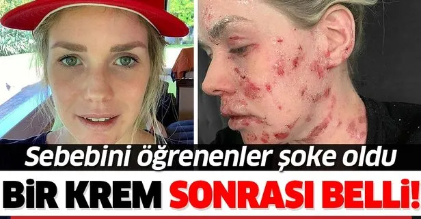 Bir krem genç kadının hayatını kararttı!