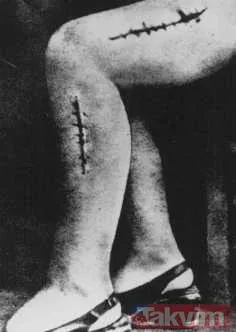 Tüberküloz (Verem): Neuengamme Toplama Kampı, Tüberküloz Deneylerinin Merkezi Oldu. Yedi Yaşındaki Jacqueline Morgenstern İle Eduard, Elisabeth Ve Alexander...