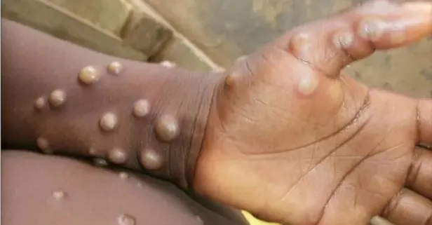 Dünya alarmda! 5 ülkede görüldü! Maymun çiçeği salgını Avrupa'yı vurdu! Maymun çiçeği hastalığı nedir, nasıl bulaşır, tedavisi var mı?