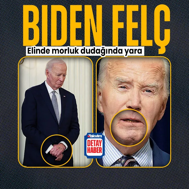 Joe Biden felç mi geçirdi? Elinde morluk, dudağında yara