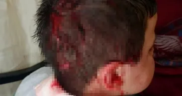 Yine pitbull dehşeti! 6 yaşındaki çocuk hayatının şokunu yaşadı! Sevmek isterken baş, kol ve kulağından yaralandı