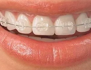 SGK diş teli tedavisi fiyatını karşılıyor mu? 2020 devlette ve özelde diş teli fiyatları nedir?