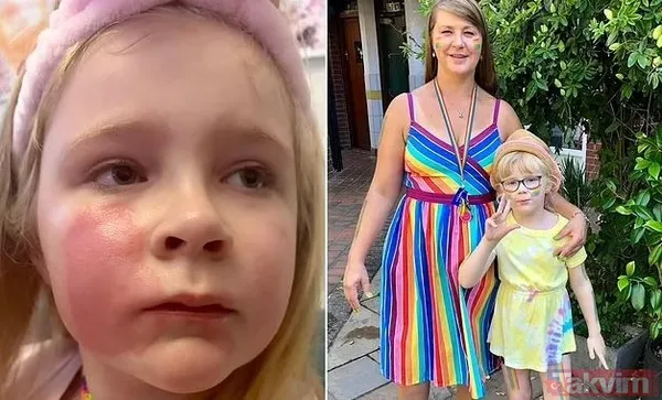 ⚠️ Popüler makyaj ürünü tehlike saçıyor! Annesinin öpücüğü küçük kızın yüzünde yanığa neden oldu - 1