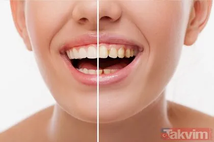 SGK diş tedavisini karşılıyor mu? İmplant, protez, ortodontik: İşte SGK’nın karşıladığı diş tedavisi rehberi