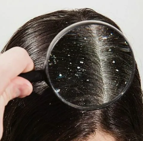 Uzmanlardan kritik uyarı! Saçınızı seviyorsanız bu şampuanı kullanmayın! Meğer yağlanma, kepek, dökülme, egzama...-6