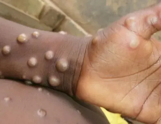 Maymun çiçeği salgını Avrupa’yı vurdu!