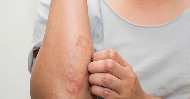 Daha çok alerji ve stres sonucu ortaya çıkan egzamaya yağ çek!