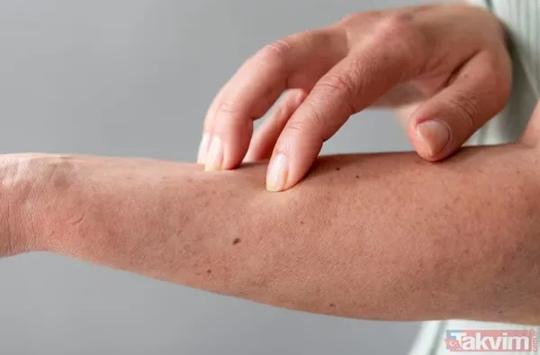 Uzmanlara Göre Bu Mevsimde Yapılan Bazı Yaygın Hatalar, Egzama Ataklarını Daha Sık Ve Yoğun Hale Getirebiliyor.